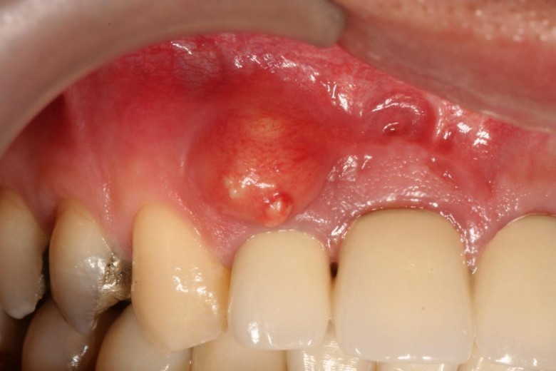 Diş Hastalıklarının En Büyük 5 Nedeni iQHaber Zekası Yüksek Sosyal