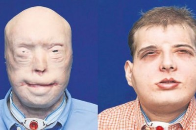 Nakli Kabul Etmeyen Vücuda İkinci Yüz Nakli