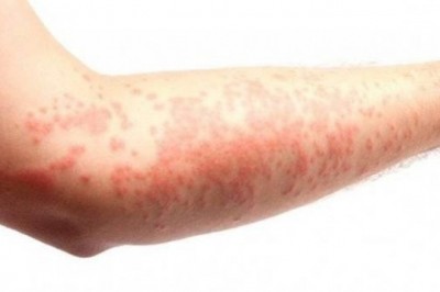 Vücutta Oluşan Yaraların Sebepleri Nelerdir?