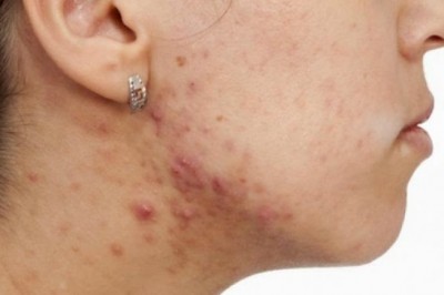 Sivilcelerden Kurtulmak İçin Yapmanız Gereken 5 Şey